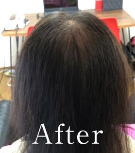 50代女性 発毛施術アフター