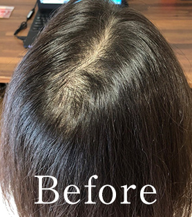 30代女性 発毛施術ビフォー