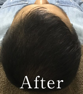 30代男性 発毛施術アフター
