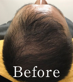 30代男性 発毛施術ビフォー