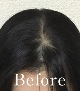 40代女性 発毛施術ビフォー