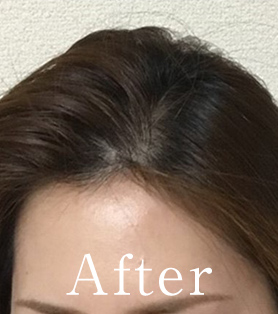 20代女性 発毛施術アフター