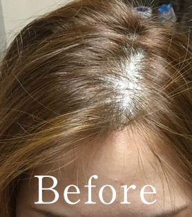 20代女性 発毛施術ビフォー