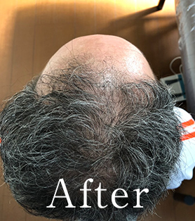 50代男性 発毛施術アフター