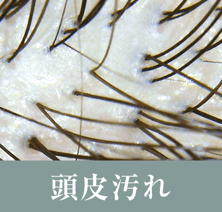 頭皮汚れ