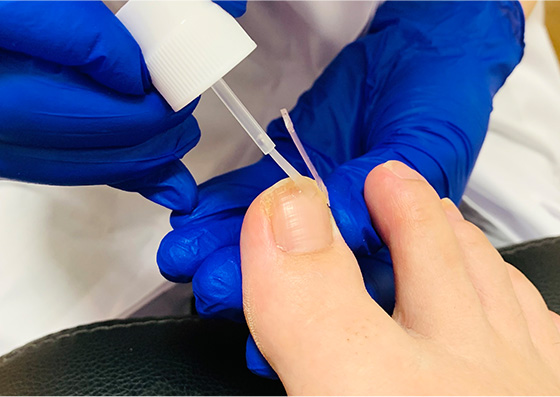 補正器具の装着