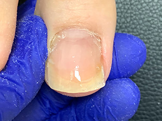 再発率が少ない